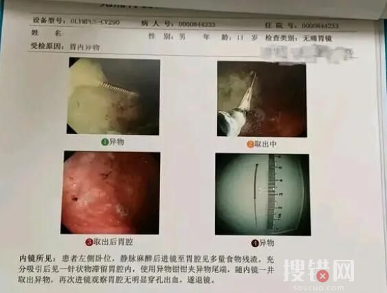 寶媽稱醫院誤將針掉進孩子胃中 為什么掉進胃中？