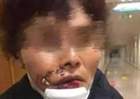 女子被狗撕碎左臉縫了500多針 原因竟是這樣太可怕了