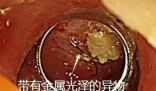 老人突發高燒拍胸片意外發現魚鉤 究竟是怎么回事？